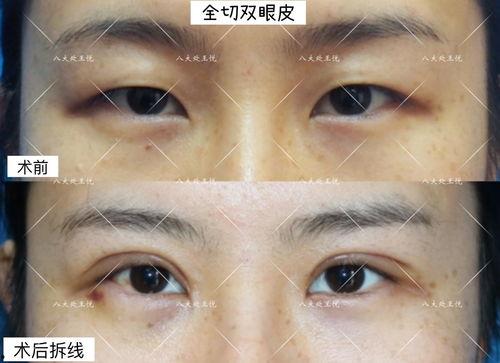 双眼皮拆线视频,专业视频教学