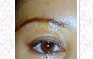 切眉缝合的视频教程,视频教程带你轻松掌握